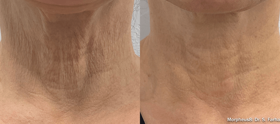 Neck Rejuvenation before treatment