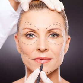 InstaLift® | Thread Lift