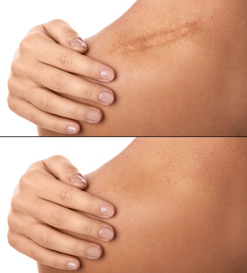 Scar Treatment